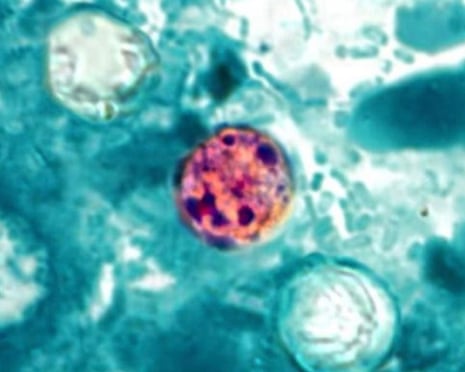 Surge in Cyclosporiasis Cases: Nearly 7,000 Suspected Across US, Linked to Foodborne Parasite